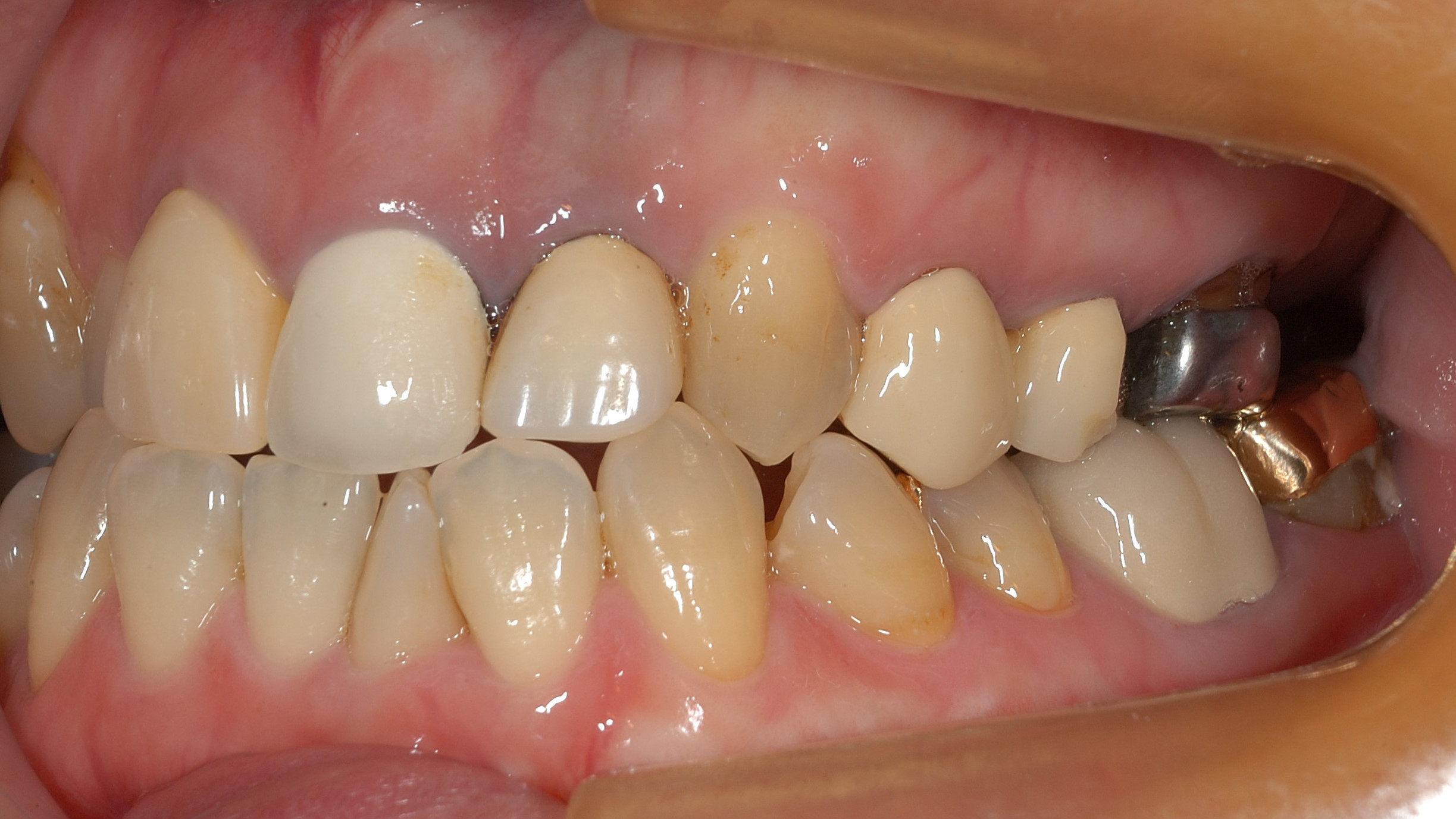 全顎審美歯科治療の一環としてのインプラント – KNB Dental Office